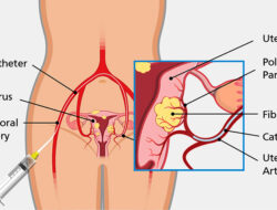 Regency Kenalkan Terobosan Perawatan Mioma Uterus Non Operasi