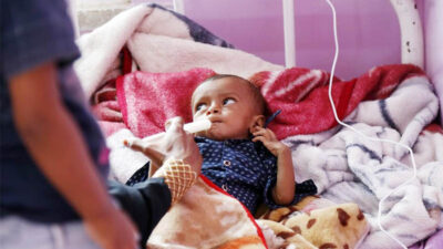 Laporan PBB Ungkap Lonjakan Kasus Malanutrisi Anak di Seluruh Daerah Yang Dikuasai Pemerintah Yaman