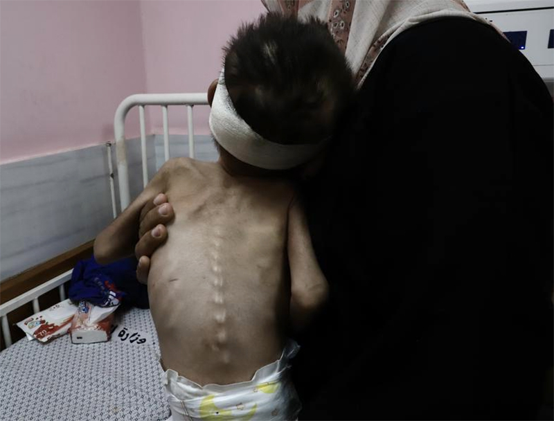 Potret Timur Tengah: Sedikitnya 57 Warga Gaza Meninggal Akibat Malanutrisi Sejak Oktober 2023